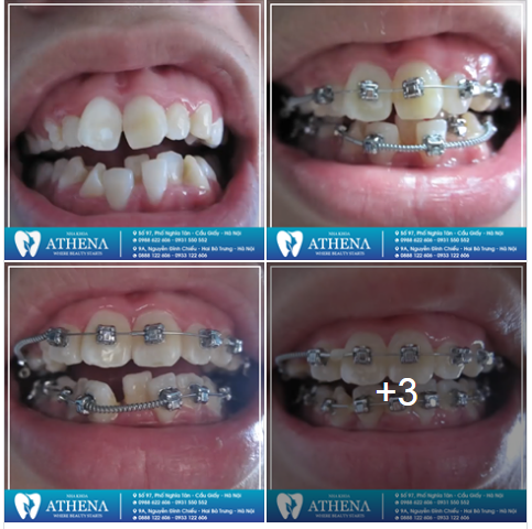 Bộ ảnh dưới đây là minh chứng cho sự thay đổi của răng trong quá trình niềng.