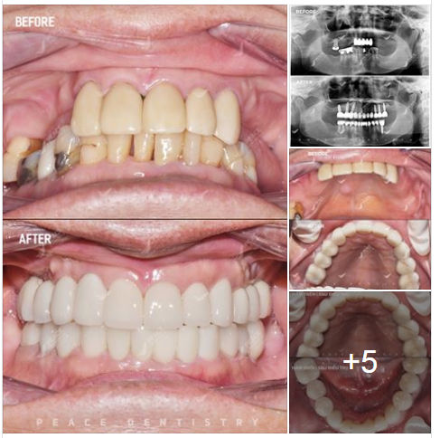  Ca lâm sàng: Cấy ghép 7 đơn vị Implant  phục hình răng sứ cho khách hàng đã gần 70 tuổi