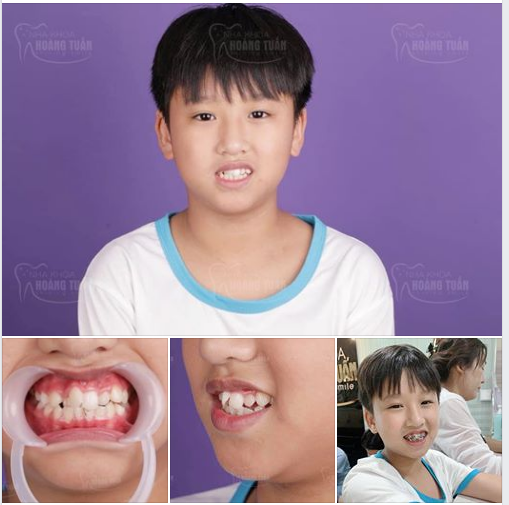  Ca niềng răng số 423 của Nha khoa - Dr Hoàng Tuấn.