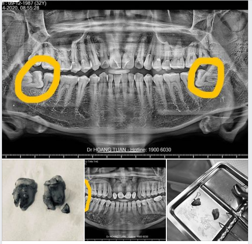 Ca sáng sương sương với 4 chú răng khôn "mọc ngu" đâm ngang trên 2 bệnh nhân nam có xương hàm siêu cứng.