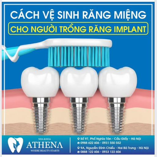 Chăm sóc răng miệng đúng cách sau khi trồng răng Implant là việc vô cùng quan trọng để duy trì độ bền của răng.