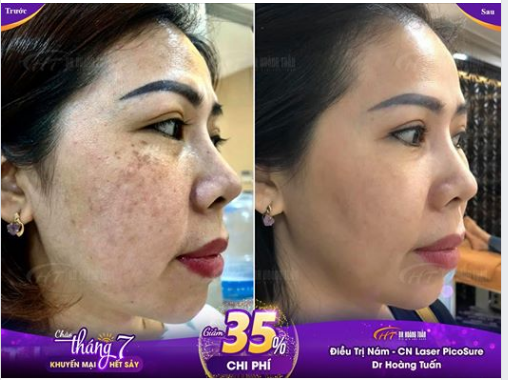 CHIÊM NGƯỠNG Kết quả sau điều trị nám tại Dr Hoàng Tuấn Không những hết nám mà làn da còn sáng hồng rạng rỡ với PicoSure!