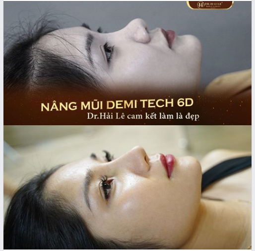 Điều gì đã khiến nâng mũi Demi Tech 6D trở thành dịch vụ "hot" tại Dr.Hải Lê 