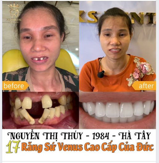 Hoàn thành bộ 17 răng sứ Venus Cao cấp của đức Tại nha khoa XS DENTAL