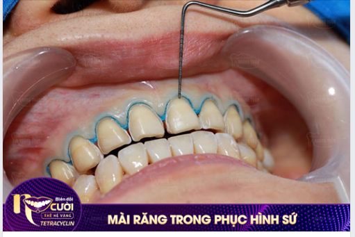 Khi nhắc đến vấn đề mài răng trong phục hình sứ, rất nhiều người lo lắng ảnh hưởng đến tuỷ hoặc tổn thương nướu.