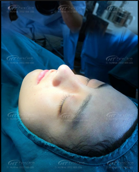 Mũi Pureform Dr Hoàng Tuấn ngay sau phẫu thuật thế này có kích thích chị em đặt lịch luôn chưa ạ?