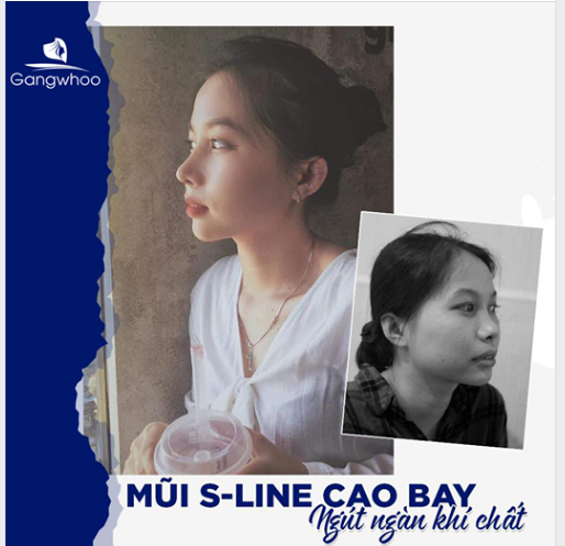 MŨI S-LINE CAO BAY – NGÚT NGÀN KHÍ CHẤT