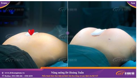 Nâng mông tại Dr Hoàng Tuấn - Nhanh chóng an toàn hiệu quả dài lâu 