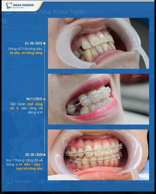  Răng sâu có niềng răng được không?