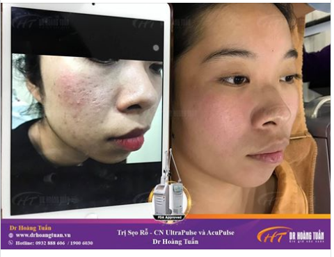 Tái tạo làn da bị sẹo rỗ do mụn để lại với công nghệ điều trị sẹo tại Dr Hoàng Tuấn