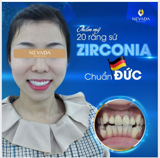 Thẩm mỹ răng sứ Zirconia chuẩn Đức Giải pháp hoàn hảo cho nụ cười tự tin 