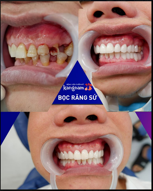 Tình trạng: Răng sâu,nhiễm Tetracycline, mất 3 răng trên dưới, bị xê dịch chân răng
