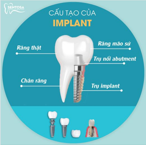 CẤU TẠO CỦA RĂNG IMPLANT 