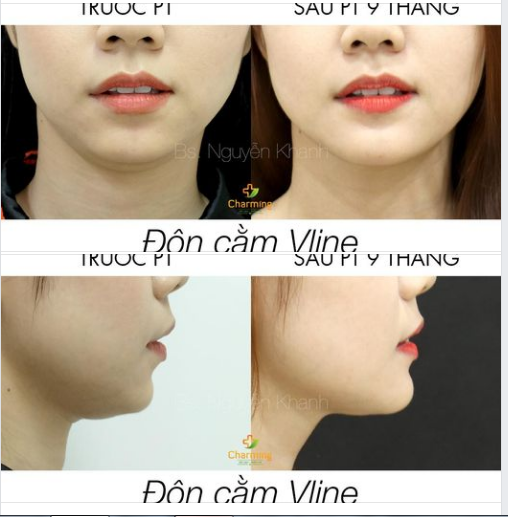 4. Đối Tượng Nên Và Không Nên Tiêm Filler Cằm