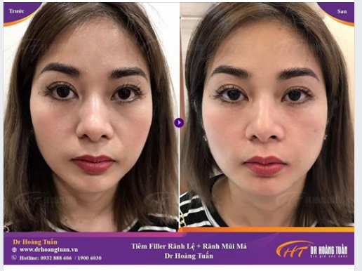 Tiêm Filler Rãnh Lệ: Giải Pháp Tối Ưu Cho Vùng Mắt Tươi Trẻ