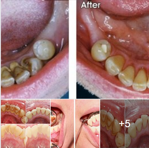 Hãy nhìn những hình ảnh sau để thấy sự khủng khiếp khi răng có những mảng bám dày đặc