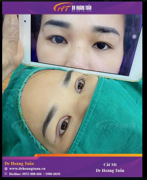 Kết quả ngay sau phẫu thuật cắt mí tại Dr Hoàng Tuấn!