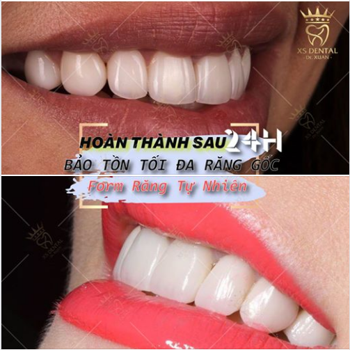 MUỐN Sở hữu hàm răng đều đẹp tự nhiên - Đến ngay Nha Khoa XS DENTAL