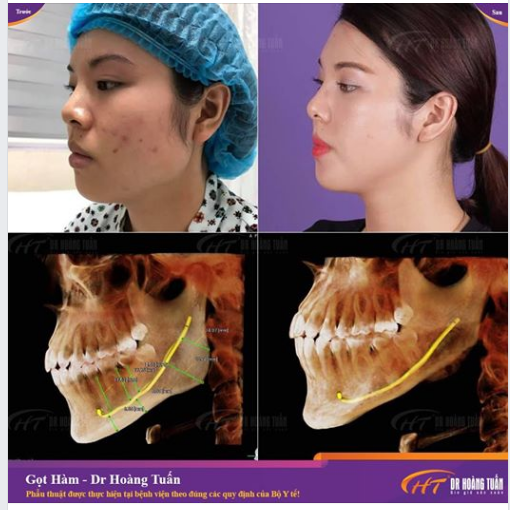 Quy trình phẫu thuật gọt hàm minh họa