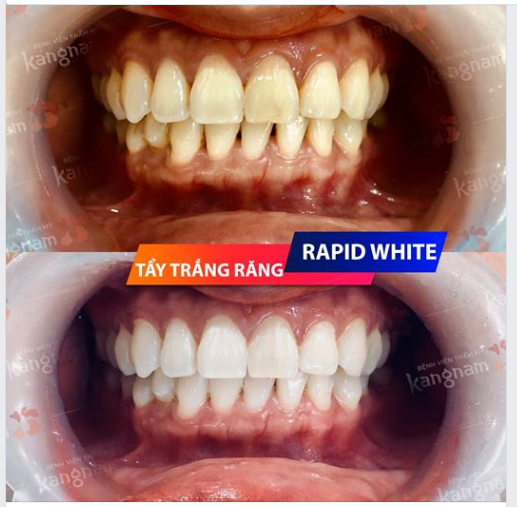 Răng trắng bật tone chỉ sau 1liệu trìnhTẨY TRẮNG RĂNG