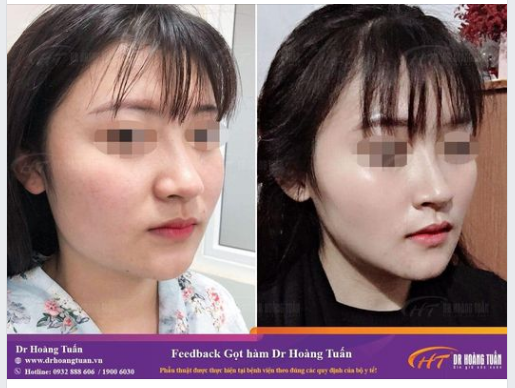 Sở hữu gương mặt chuẩn Vline nhờ công nghệ gọt hàm C-shape tại Dr Hoàng Tuấn!