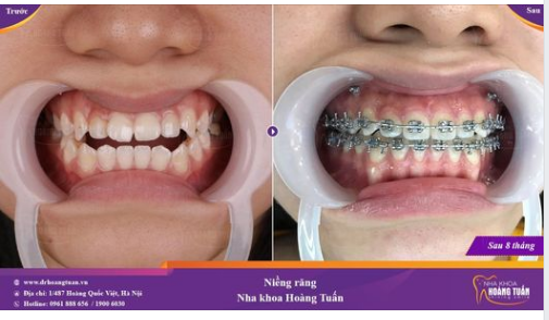 Tiến triển sau 8 tháng niềng răng mắc cài titan tại Nha khoa Dr Hoàng Tuấn
