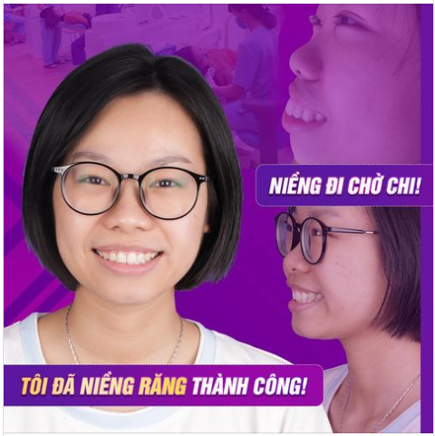 Tôi từ Phú Thọ xuống Hà Nội và đến Nha khoa - Dr Hoàng Tuấn để NIỀNG RĂNG.