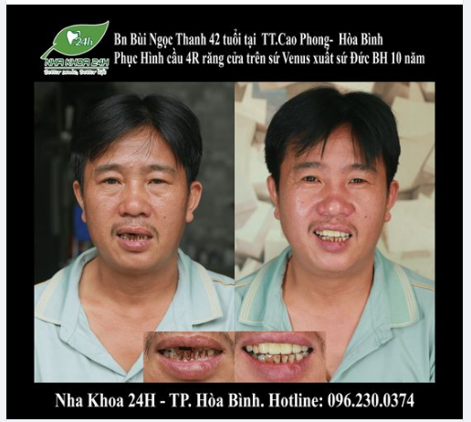 BN Bùi Ngọc Thanh 42 tuổi ở TT. Cao Phong đến với Nha Khoa 24H trong tình trạng các răng cửa trên bị tiêu xương, tụt lợi, chỉ còn chân răng.