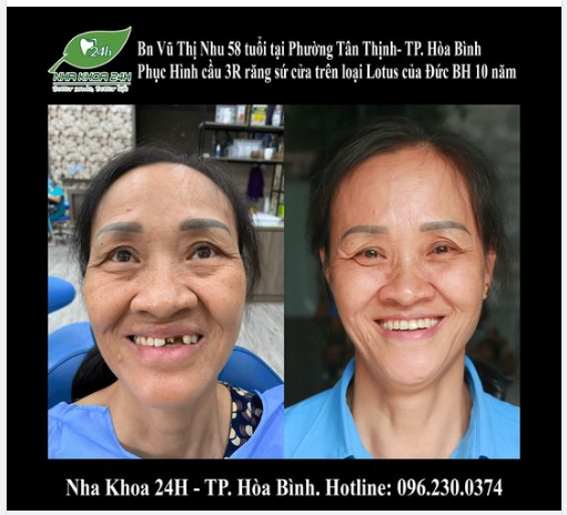 BN Vũ Thị Nhu 58 tuổi ở Phường đến với Nha Khoa 24H trong tình trạng mất răng cửa và một răng đang điều trị dang dở.