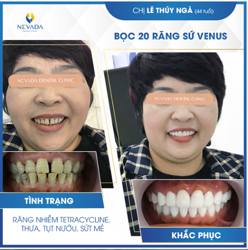 "BỌC RĂNG SỨ ĐÃ THAY ĐỔI CUỘC ĐỜI TÔI..."