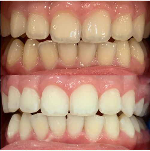 Ca tẩy trắng răng  của nha khoa XS dental