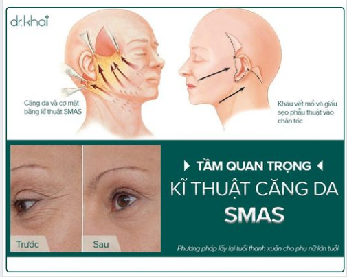 Căng da mặt SMAS là gì