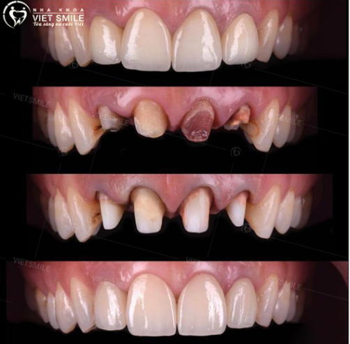  Case thực hiện tháo 4 răng sứ cũ và lên răng sứ mới tại VIET SMILE