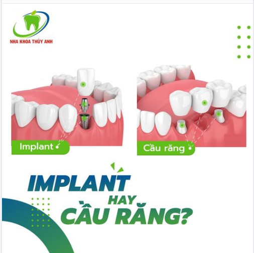 Cầu răng hay chân răng nhân tạo implant cho người mất răng