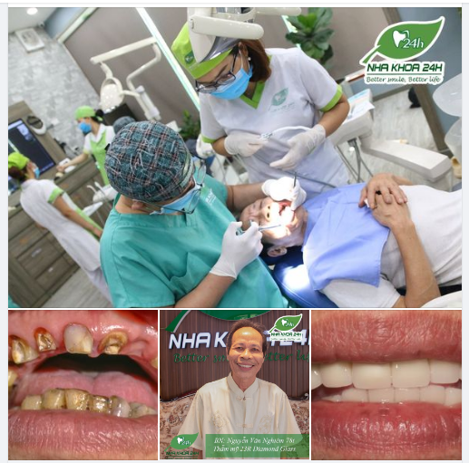 Để răng sứ luôn chắc khỏe, bền đẹp, các bác sĩ bọc răng sứ đưa ra hướng dẫn chế độ chăm sóc răng sau bọc sứ chi tiết như sau