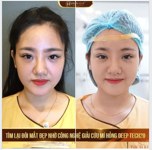  Đến với Dr.Hải Lê, để sở hữu ngoại hình xinh đẹp, rạng rỡ với các dịch vụ thẩm mỹ mắt cao cấp.