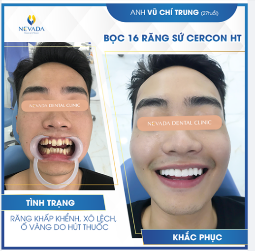 ĐẸP XUẤT SẮC VỚI CASE BỌC RĂNG SỨ RĂNG KHẤP KHỂNH(9-6-3-0) - XỈN MÀU TẠI NEVADA