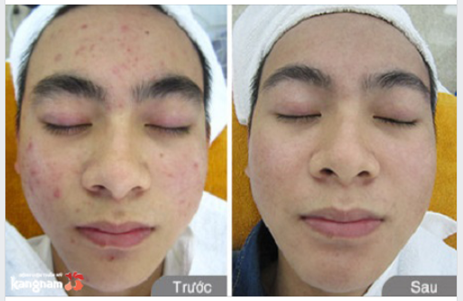 Hết mặt mụn sau 5 buổi trị mụn De-acne