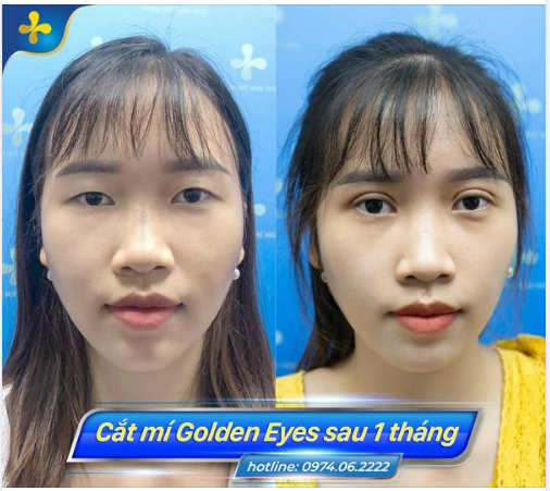 Hình ảnh bạn gái Ngọc Mai sau 1 tháng cắt mí GOLDEN EYES tại Dr.Tống Hải.