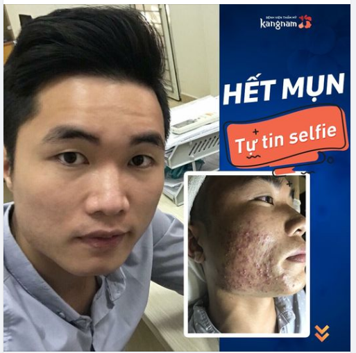 Hình ảnh selfie khách hàng gửi cho BVTM Kangnam sau khi kết thúc liệu trình trị mụn 10 buổi