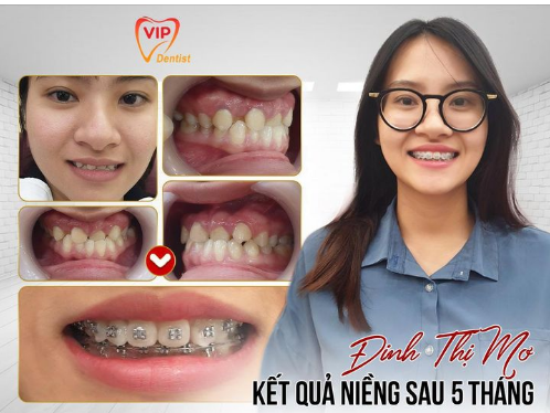 Trải nghiệm niềng răng 5 năm và những lợi ích của niềng răng