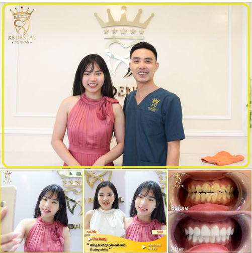 KH: Hà Vy Siêu Đẹp Sau khi làm răng sứ thẩm mỹ tại nha khoa  XS DENTAL 