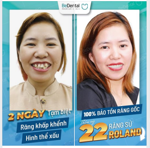 KH Việt kiều về nước thay đổi hàm răng khấp khểnh và nhận kết quả bất ngờ!!!
