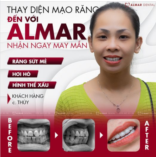 Khách hàng: chị Thanh Thúy đã Xinh Đẹp và Tự Tin hơn sau quá trình thẩm mỹ 18 răng sứ cao cấp tại nha khoa Almar Dental