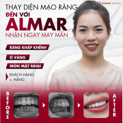 Khách Hàng Sau Khi Làm " 16 Răng Sứ Cao Cấp DDBIO " Tại Almar Dental