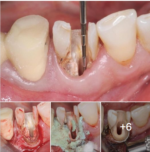Một ca điều trị tủy với tình trạng sâu mủn cổ Răng dưới lợi