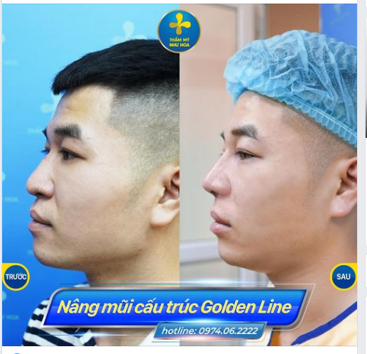 Mũi tiêm filler và mũi cấu trúc Golden Line do trực tiếp Dr.Tống Hải thực hiện.