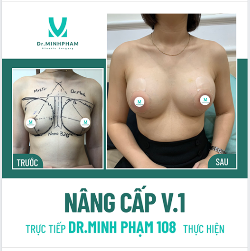 Nâng V1 nội soi trực tiếp Dr Minh Phạm 108 thực hiện