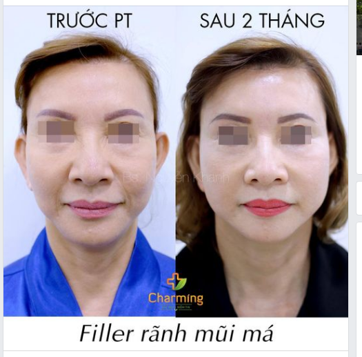 Nhìn hai tấm ảnh trước và sau khi tiêm Filler rãnh mũi má bên dưới là bạn có thể thấy rất rõ sự khác biệt.