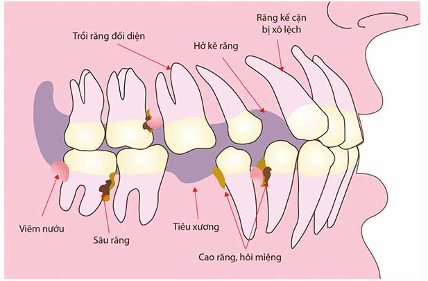 Những hậu quả khi mất răng vĩnh viễn